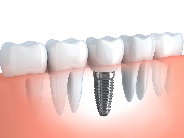 Tooth human implant (done in 3d graphics) CODY