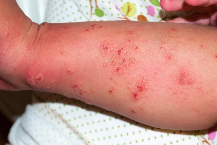 can scabies live in mattresses